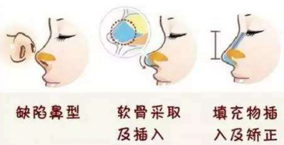 鞍鼻整形后对比照 鞍鼻整形后对比照