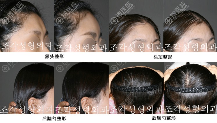 韩国雕刻医院宋龙泰骨水泥填充术效果展示 韩国雕刻医院宋龙泰骨水泥填充术效果展示