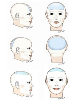 骨水泥填充适用范围 骨水泥填充适用范围