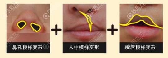 唇腭裂表现症状 唇腭裂表现症状