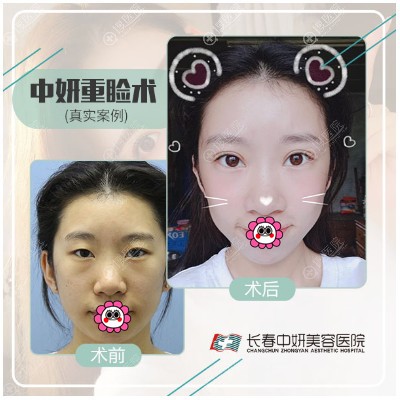 长春中妍刘晓吉双眼皮案例 长春中妍刘晓吉双眼皮案例