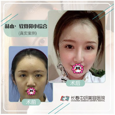 长春中妍隆鼻效果怎么样 长春中妍隆鼻效果怎么样