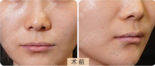 注射丰唇前嘴唇过薄 注射丰唇前嘴唇过薄