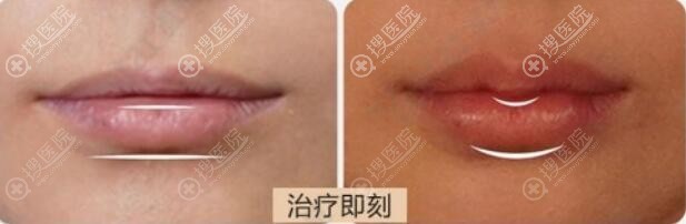 玻尿酸丰唇前后对比 玻尿酸丰唇前后对比