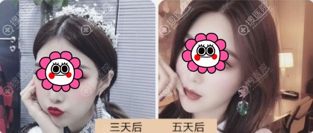 玻尿酸丰唇恢复后的效果 玻尿酸丰唇恢复后的效果