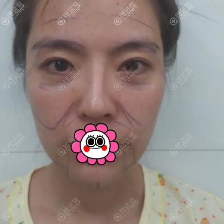 到沈阳名流做自体脂肪填充全脸前 到沈阳名流做自体脂肪填充全脸前