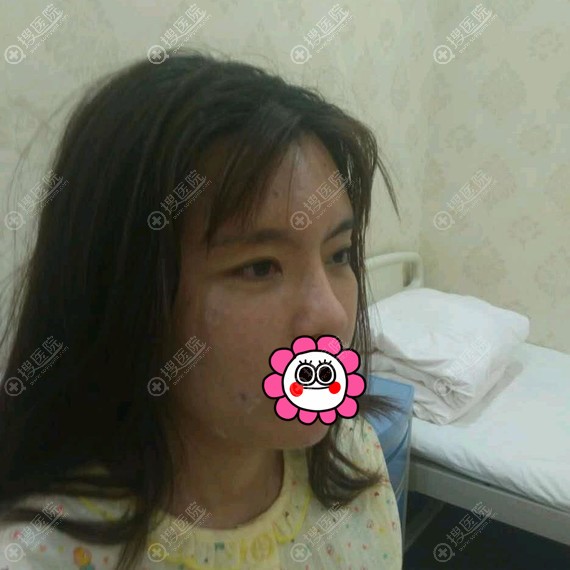 做完自体脂肪填充全脸术后即刻 做完自体脂肪填充全脸术后即刻