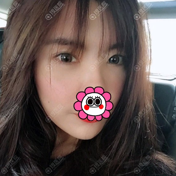 沈阳名流自体脂肪全脸填充效果 沈阳名流自体脂肪全脸填充效果