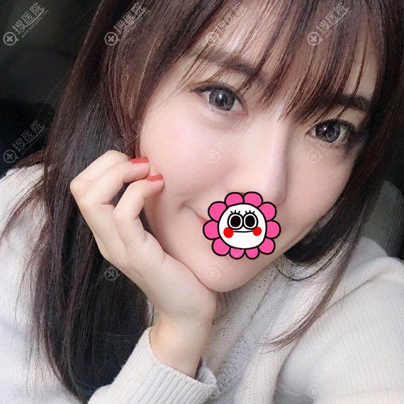 沈阳名流王松自体脂肪填充面部效果图 沈阳名流王松自体脂肪填充面部效果图