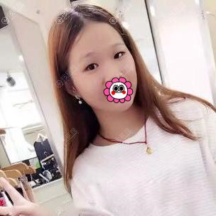 做双眼皮手术前 做双眼皮手术前