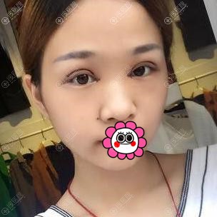 双眼皮术后一周到医院拆线 双眼皮术后一周到医院拆线