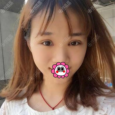 苏州卫康双眼皮恢复半个月效果 苏州卫康双眼皮恢复半个月效果