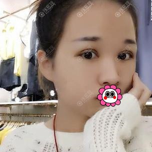 苏州卫康双眼皮效果怎么样 苏州卫康双眼皮效果怎么样