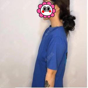 做假体隆胸前 做假体隆胸前