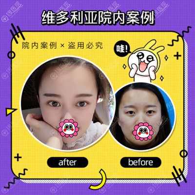 安徽维多利亚双眼皮案例 安徽维多利亚双眼皮案例