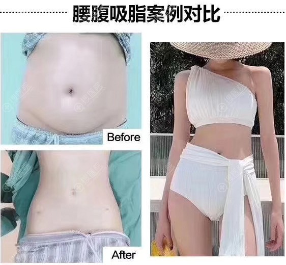 温州艺星腰腹吸脂案例 温州艺星腰腹吸脂案例