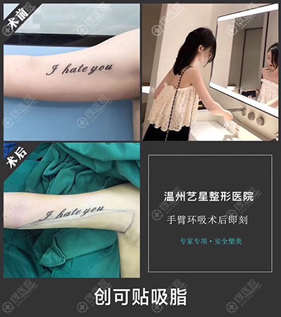 温州艺星手臂吸脂案例 温州艺星手臂吸脂案例