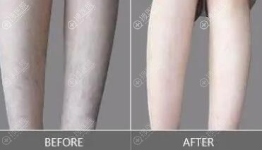 腿部脱毛对比图 腿部脱毛对比图