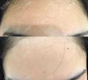 额头脱毛对比图 额头脱毛对比图