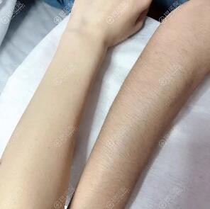 手臂脱毛对比 手臂脱毛对比