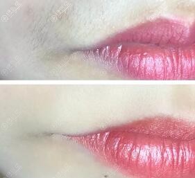唇部脱毛对比 唇部脱毛对比