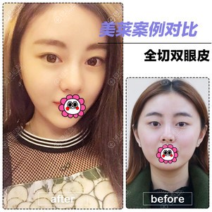 北京美莱双眼皮效果怎么样? 北京美莱双眼皮效果怎么样?
