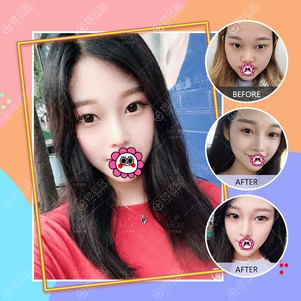 北京美莱王旭东隆鼻效果怎么样? 北京美莱王旭东隆鼻效果怎么样?