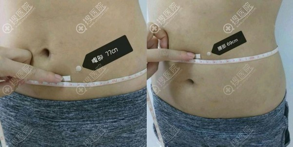 到贵阳美贝尔做腰腹吸脂前 到贵阳美贝尔做腰腹吸脂前