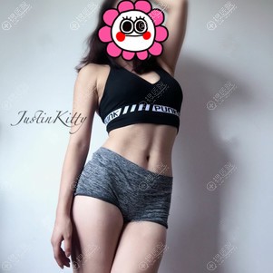 贵阳美贝尔做腰腹吸脂案例 贵阳美贝尔做腰腹吸脂案例