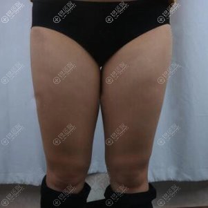 到昆明韩辰做吸脂前 到昆明韩辰做吸脂前