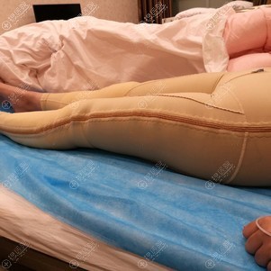 吸脂术后头天 吸脂术后头天