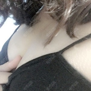沧州静港自体脂肪隆胸拆线后 沧州静港自体脂肪隆胸拆线后