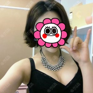 自体脂肪丰胸恢复一个月效果 自体脂肪丰胸恢复一个月效果