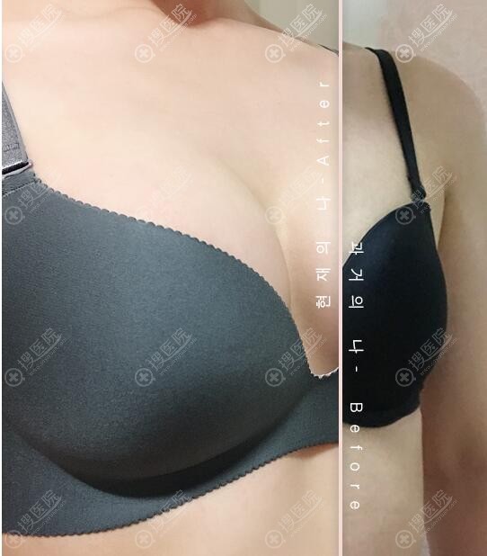 韩国NANA整形医院黄铜渊隆胸案例 韩国NANA整形医院黄铜渊隆胸案例