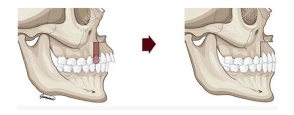 正颌手术示意图 正颌手术示意图