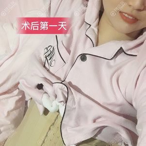 腰腹吸脂术后头天 腰腹吸脂术后头天