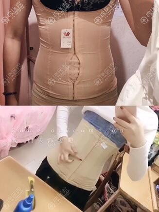 到成都艾米丽做腰腹吸脂术后恢复8天效果对比 到成都艾米丽做腰腹吸脂术后恢复8天效果对比