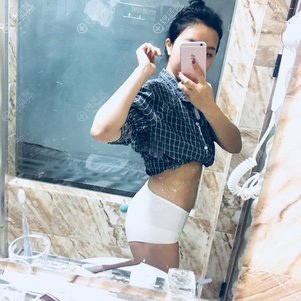 成都艾米丽潘红伟腰腹吸脂两个月效果 成都艾米丽潘红伟腰腹吸脂两个月效果