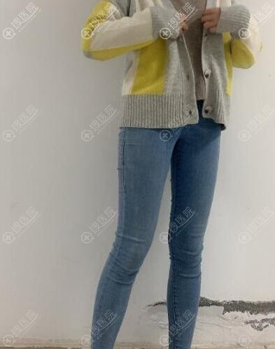 大腿吸脂术后恢复一个月效果 大腿吸脂术后恢复一个月效果