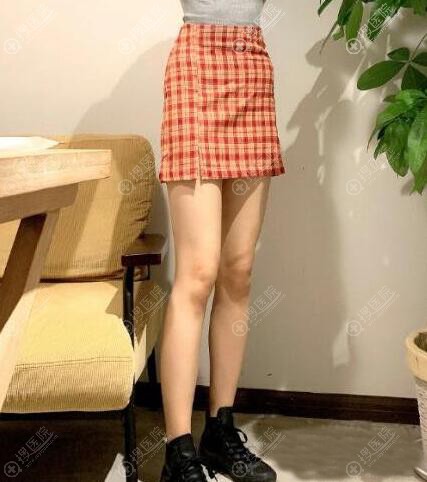 宁波薇琳曾举大腿吸脂恢复三个月案例 宁波薇琳曾举大腿吸脂恢复三个月案例