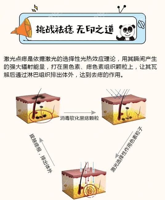 激光祛除色素痣原理图 激光祛除色素痣原理图