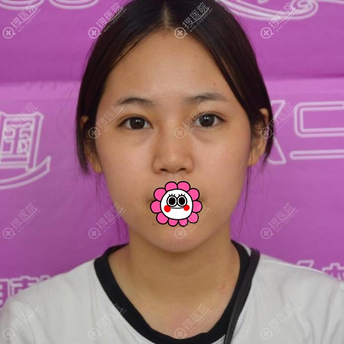 到南宁梦想做假体隆鼻前 到南宁梦想做假体隆鼻前