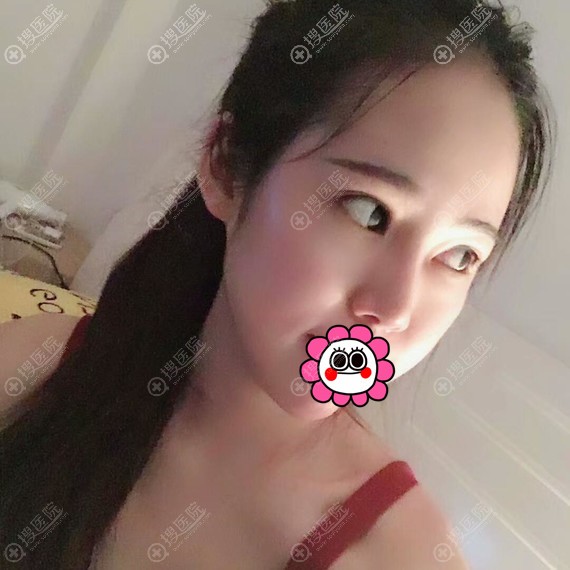 南宁梦想耳软骨隆鼻恢复7天 南宁梦想耳软骨隆鼻恢复7天