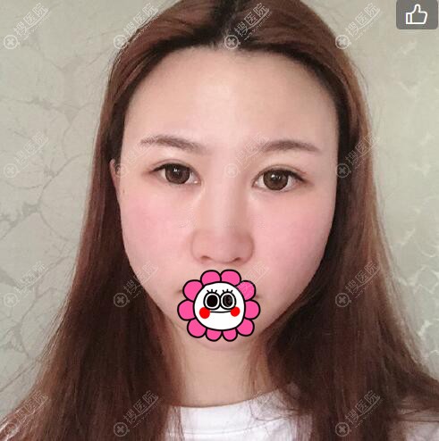 到太原时光做隆鼻前 到太原时光做隆鼻前