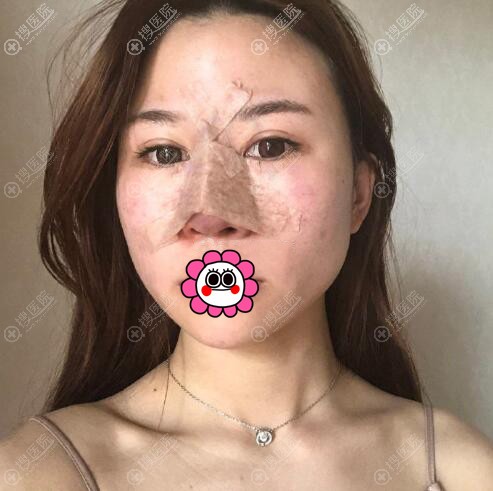 太原时光张国军硅胶隆鼻术后即刻 太原时光张国军硅胶隆鼻术后即刻