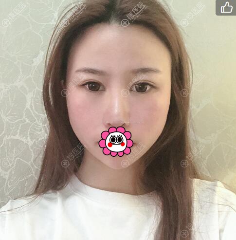 硅胶隆鼻术后7天拆线效果 硅胶隆鼻术后7天拆线效果