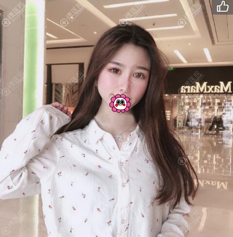 太原时光张国军硅胶隆鼻术后恢复效果 太原时光张国军硅胶隆鼻术后恢复效果