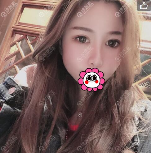 太原时光张国军隆鼻效果怎么样 太原时光张国军隆鼻效果怎么样