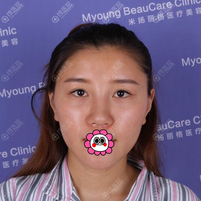 到昆山米扬丽格做隆鼻前 到昆山米扬丽格做隆鼻前