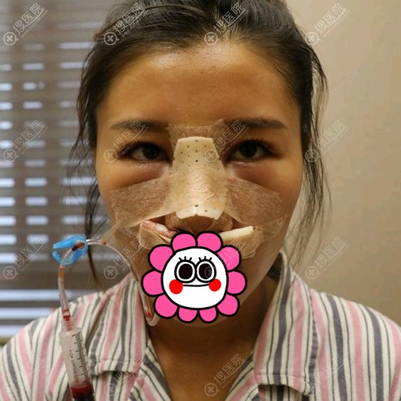 在昆山米扬丽格隆鼻术后 在昆山米扬丽格隆鼻术后